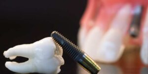 dental implants in London