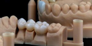 cómo son los puentes dentales