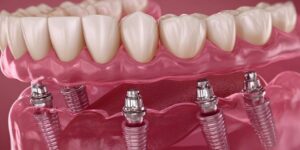 dental implants all on 4