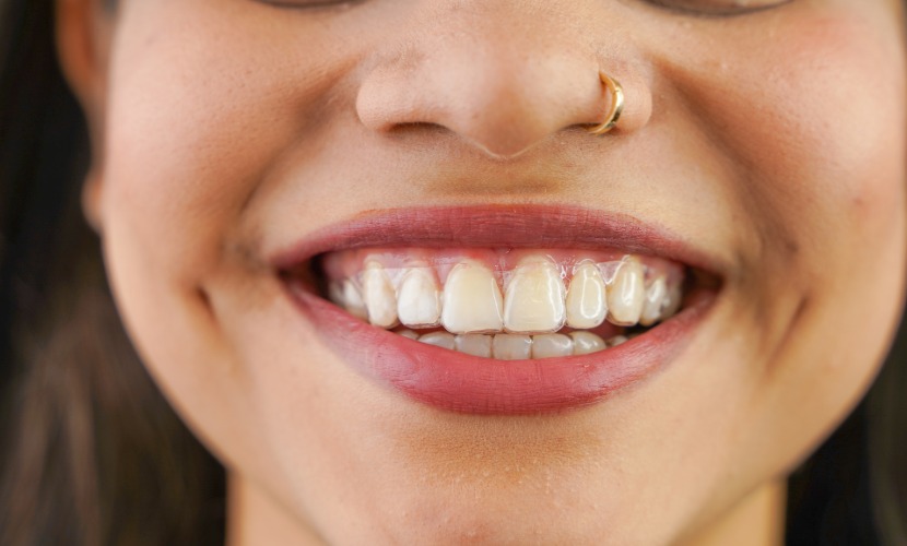 Primer plano de una sonrisa con un alineador transparente colocado